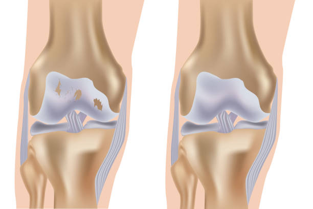 Illustration of recurrent disc herniation