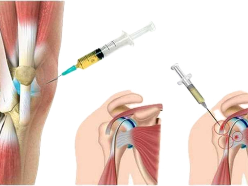 Illustration of a PRP injection