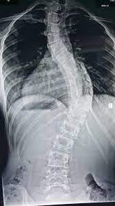 Illustration of scoliosis