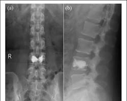 Image of a vertebra after stent placement